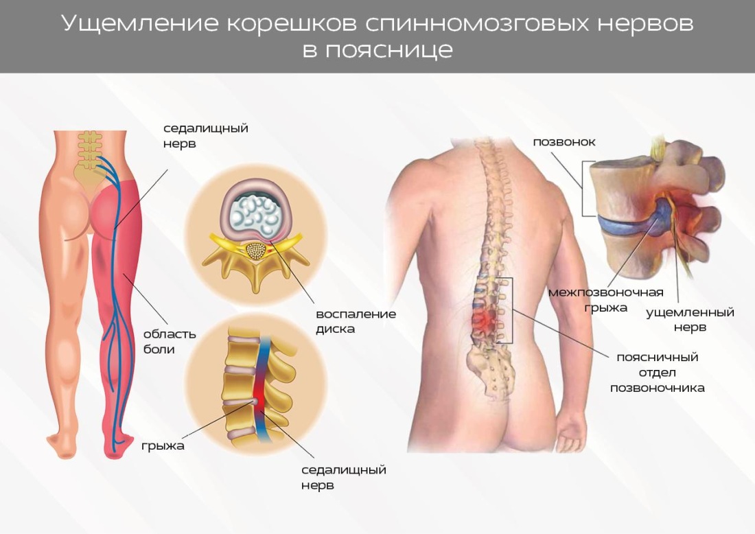 Грыжа пояснично-крестцового отдела симптомы