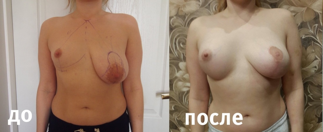 Ассиметрия груди до и после